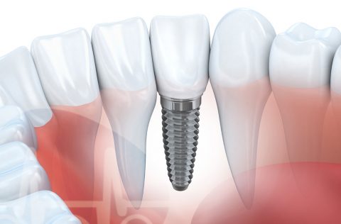 implantes dentários amarante